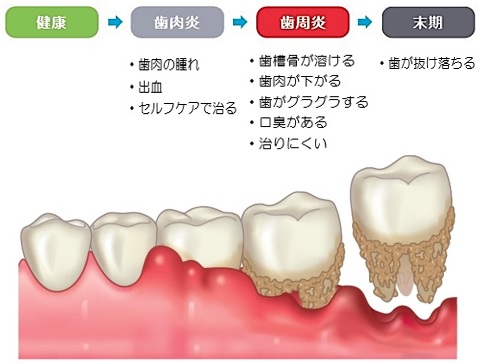 ステージ別歯周病